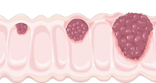 Colon Cancer: The Complete Guide